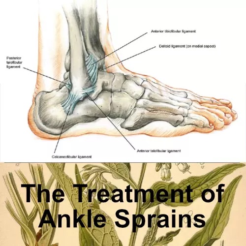 Thumbnail for Treatment of Ankle Sprains.