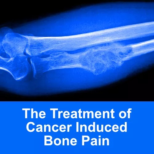 Thumbnail for Treatment of Cancer-Induced Bone Pain.