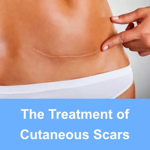 Thumbnail for Treatment of Cutaneous Scars.