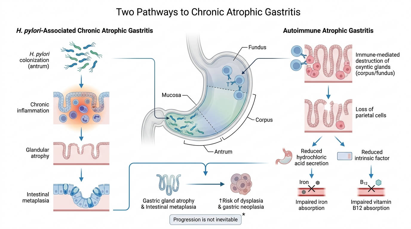 Diagram comparing H. pylori-associated and autoimmune pathways to chronic atrophic gastritis.