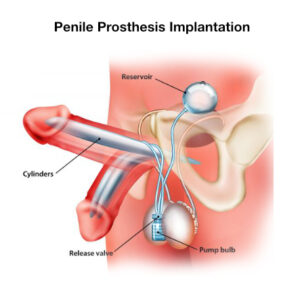 Penile implant figure from the original Peyronie's article.