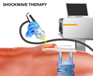 Shockwave therapy figure from the original Peyronie's article.