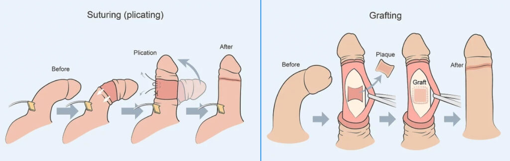 Surgery figure from the original Peyronie's article.