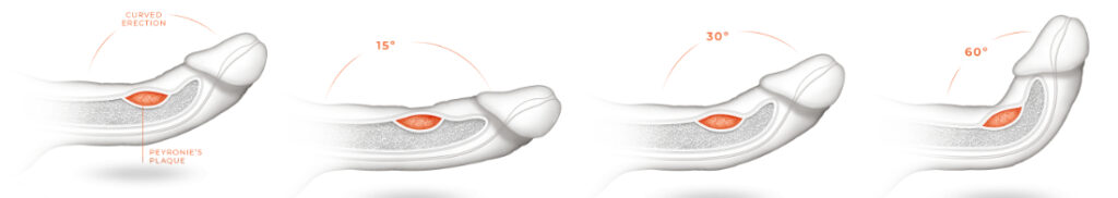 Clinical figure showing three angles relevant to Peyronie's disease evaluation.