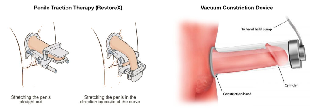 Penile traction therapy illustration from the original Peyronie's article.