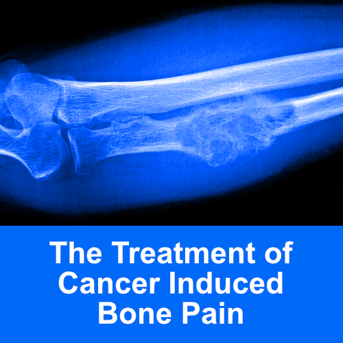 the treatment of cancer induced bone pain