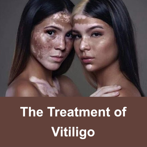 the treatment of vitiligo