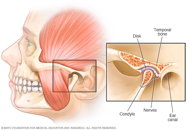 TMJ and Acupuncture