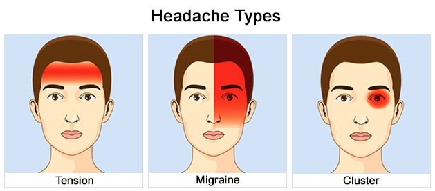headaches migraines and integrative medicine - types of headache